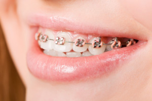 Dental Braces